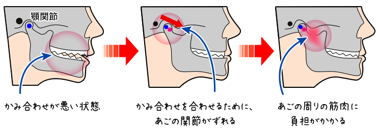 整体 噛み 合わせ