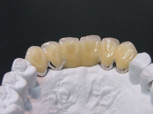 インプラントとブリッジどちらがいいか?歯科医がお答えします。メリットデメリット