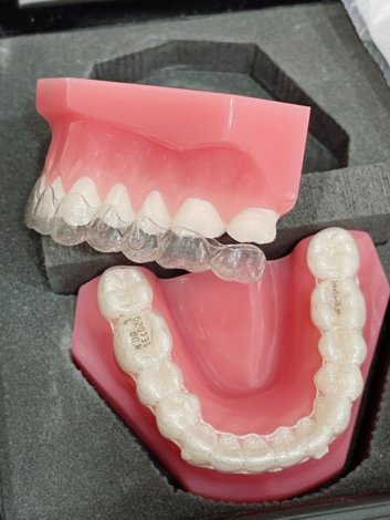 インビザライン模型