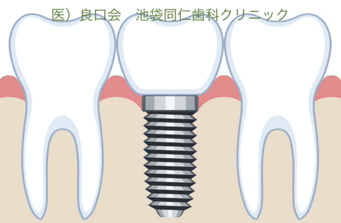 インプラント治療の期間