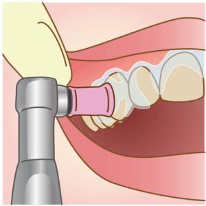 歯医者 クリーニング