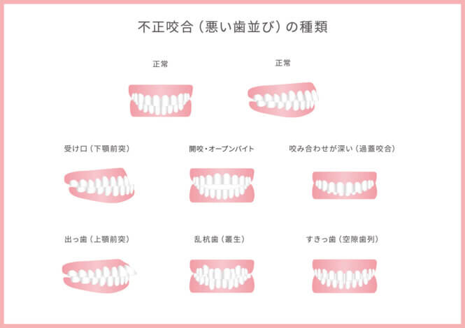 インビザライン矯正で軽度の不正咬合を治すには？おすすめの治療法