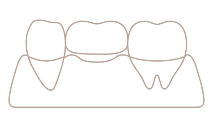 ブリッジ　メリットデメリット
