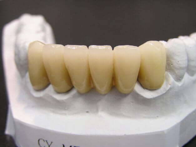 前歯　ブリッジ