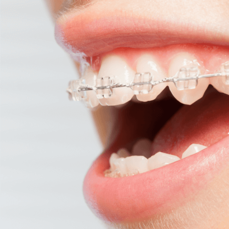 【歯周病でも歯列矯正できるの？】