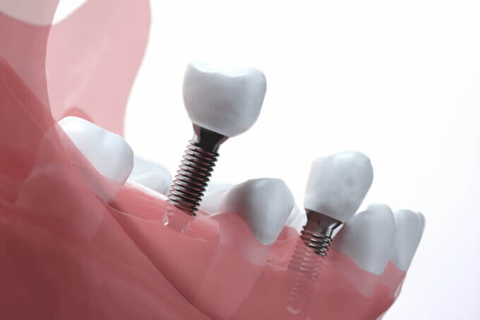 歯周病でもインプラントは入れられる？【歯周病とインプラント】