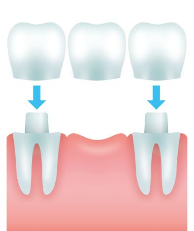 ブリッジ治療で白い歯にすることは可能？費用や治療にかかる期間