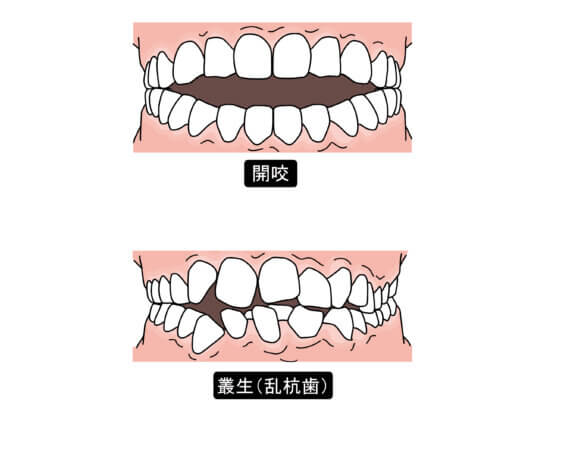 噛んだ時に前歯が当たらない！【開咬】問題ある噛み合わせ？