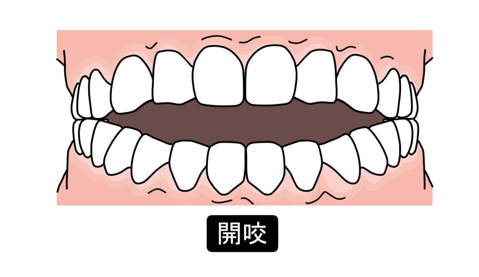 噛んだ時に前歯が当たらない！【開咬】問題ある噛み合わせ？ | 創業70