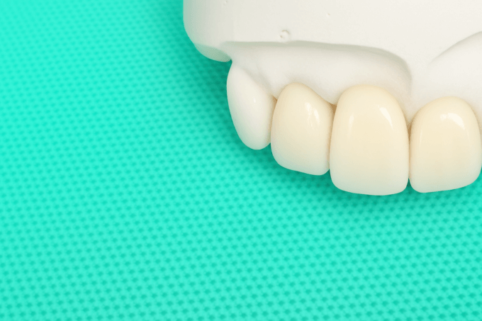 インビザラインは差し歯があっても問題ない？治療中に差し歯を入れる場合
