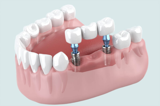 インプラントブリッジとは？〜3本タイプからフルブリッジなど